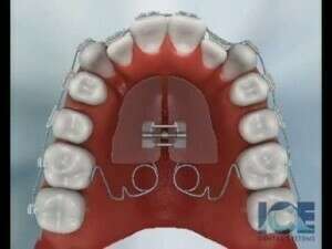 Class II Crowding (Upper)