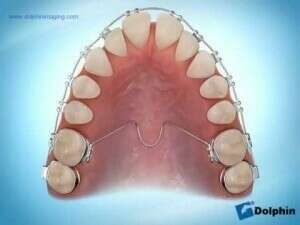Transpalatal Arch (TPA)