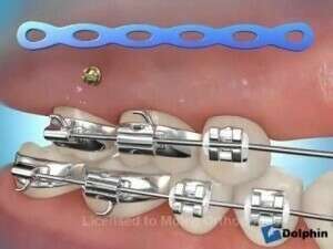 MINIVIS RETRACTION ANTERIEURE