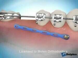 MINIVIS MESIALISATION MOLAIRE