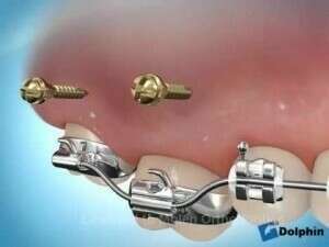 MINIVIS INTRUSION MOLAIRE AVEC MULTIBAGUE