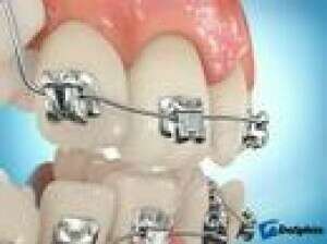 MULTI-ATTACHES DAMON