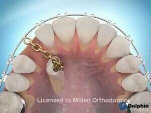 Dégagement d'une canine incluse