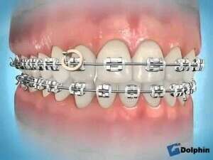 Elastiques en criss cross