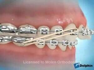 Vidéo élastique inter maxillaire de classe II