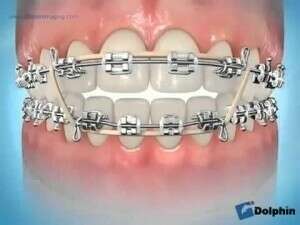 Vidéo élastique inter maxillaire de classe III