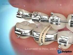 Vidéo élastique inter maxillaire transverses