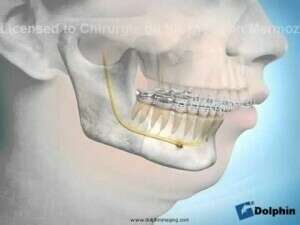 Chirurgie de la classe II