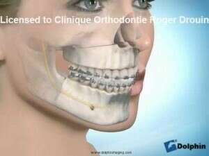 chirurgie de la classe III