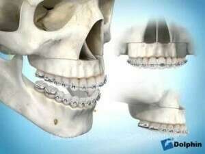 CHIRURGIE IMPACTION MAXILLAIRE