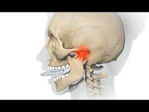 GOUTTIERE DE DECOMPRESSION NEUROMUSCULAIRE