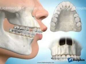 Extraction de 2 premolaires pour réduire l'encombrement