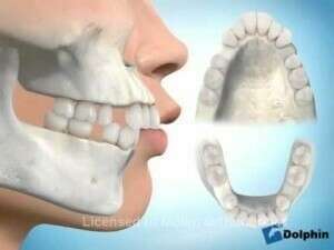 Extraction 14 24 35 45