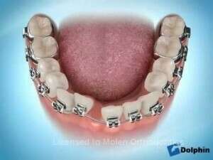 Extraction une incisive mandibulaire