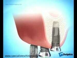 Greffes osseuses avant la pose d'implants