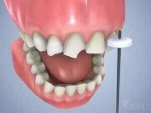 Facettes dentaires en ceramique porcelaine