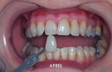 BLANCHIMENT REALISE AU CABINET D'AUBENAS