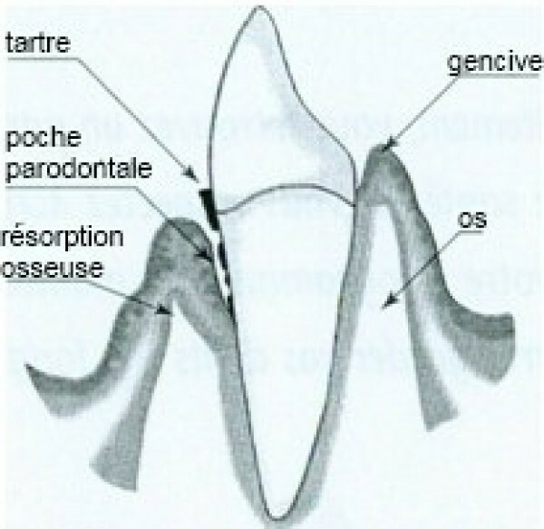 Êtes vous atteint d'une maladie parodontale ?