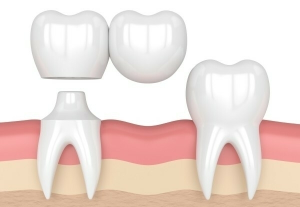 Le bridge cantilever et le bridge collé