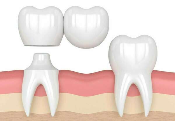 Bridge cantilever et bridge collé