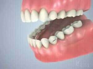 Prothèse dentaire partielle (partiel)