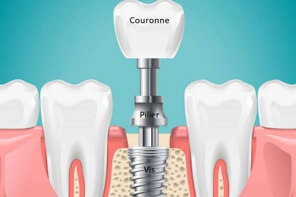 Les différentes pièces d’un implant