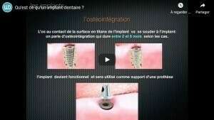 Qu'est-ce qu'un implant dentaire ?