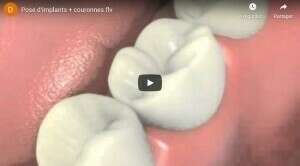 Pose d'implants et couronnes