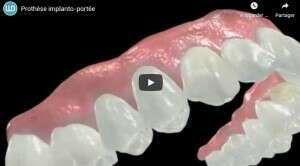 Prothèse implanto-portée