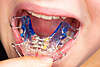 orthodontie-interceptive-paris-17