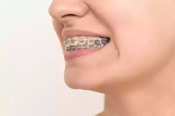 LES ÉLASTIQUES EN ORTHODONTIE