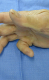 Hand pathologies | Surgery in Paris and Montigny