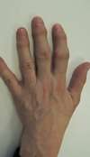 Hand pathologies | Surgery in Paris and Montigny