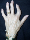 hand arthrosis