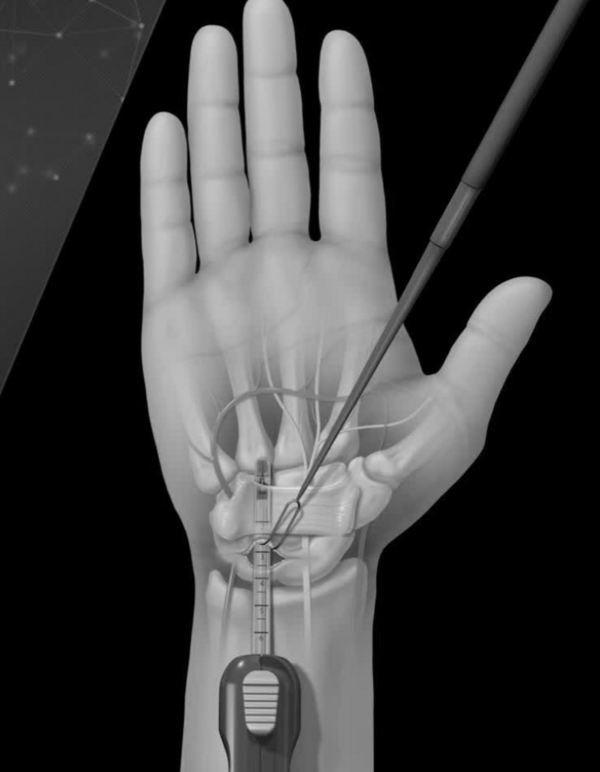 Ultrasound-guided surgery: a new approach to minimally invasive surgery