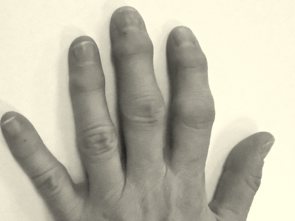 Osteoarthritis of the fingers: when pain becomes a handicap