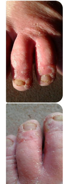 FOOT FUNGUS AND WEEDS