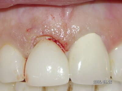 REMODELAGE GINGIVAL AU LASER