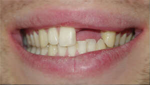 REMPLACEMENT DE DEUX INCISIVES PAR DES COURONNES CÉRAMIQUES SUR IMPLANTS