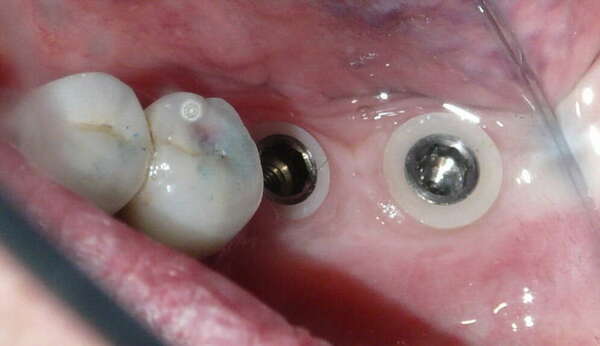 POSE DE DEUX COURONNES CÉRAMIQUES SUR IMPLANTS MOLAIRES MANDIBULAIRES