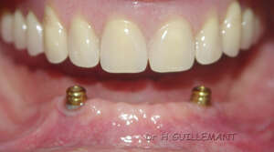 PROTHÉSE COMPLÉTE MANDIBULAIRE STABILISÉE PAR DEUX ATTACHEMENTS