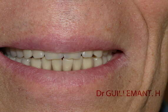 PROTHÈSE COMPLÈTE MANDIBULAIRE SUR QUATRE IMPLANTS