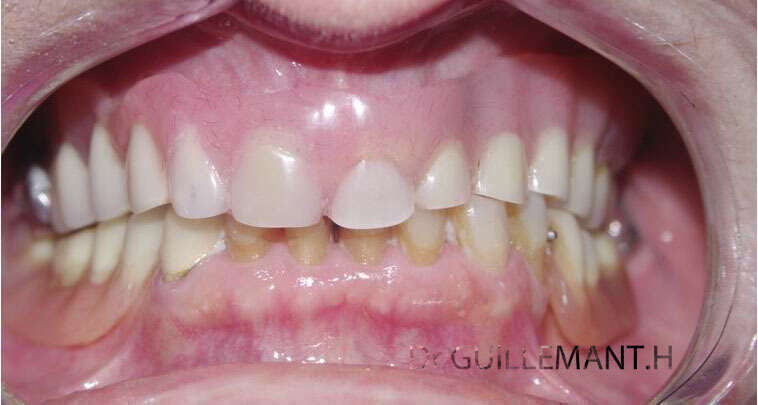 PROTHÈSE MAXILLAIRE SUR SIX IMPLANTS