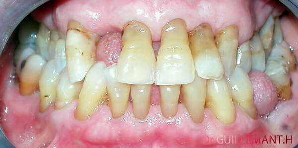 COURONNE TOUT CÉRAMIQUE CARRACTÉRISÉE SUR IMPLANT