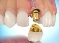 PROTHÈSE DENTAIRE SUR IMPLANT