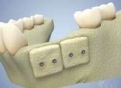 LES GREFFES OSSEUSES PRÉ-IMPLANTAIRES