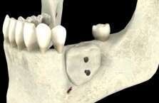 LA GREFFE OSSEUSE D'APPOSITION OU GREFFE EN ONLAY