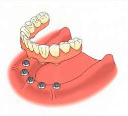 REMPLACER TOUTES LES DENTS : QUELLE PROTHÈSE CHOISIR