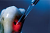 Spécialité LASER