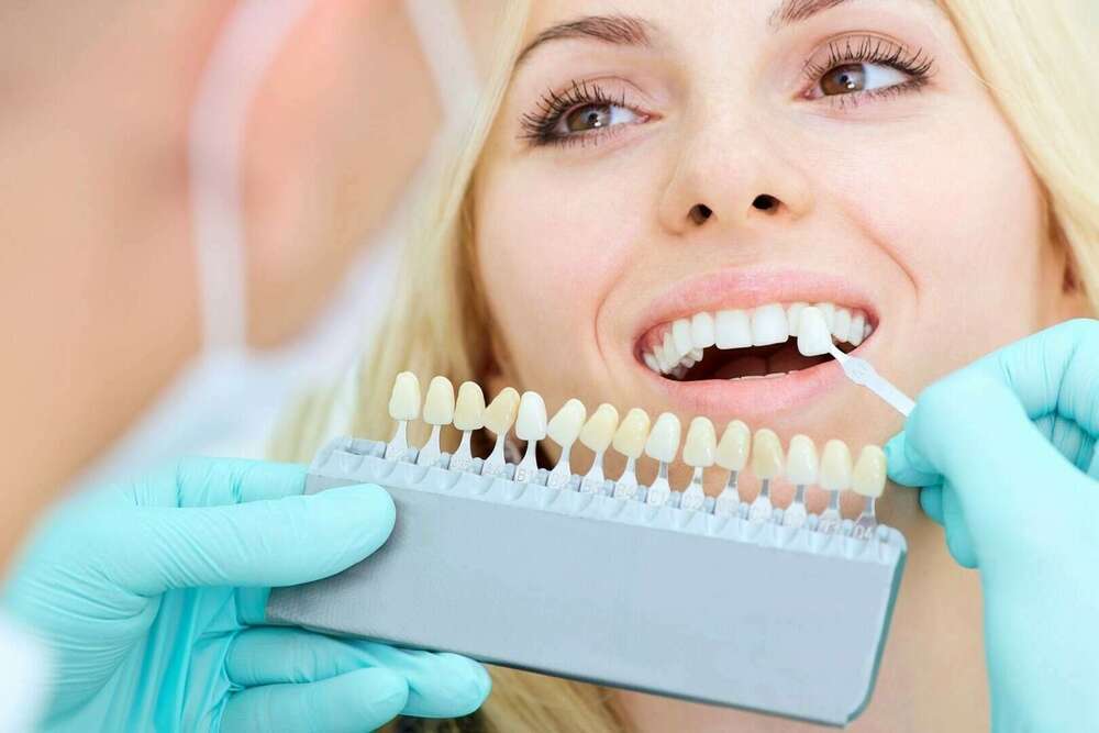 3 - Facettes Dentaires Paris : Facette dentaire en céramique collées pour un sourire éclatant